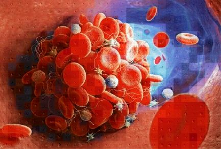 ابزار جدیدی که لختههای خون را شناسایی میکند