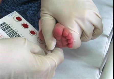 جزئیات غربالگری کم‌کاری تیروئید در نوزادان